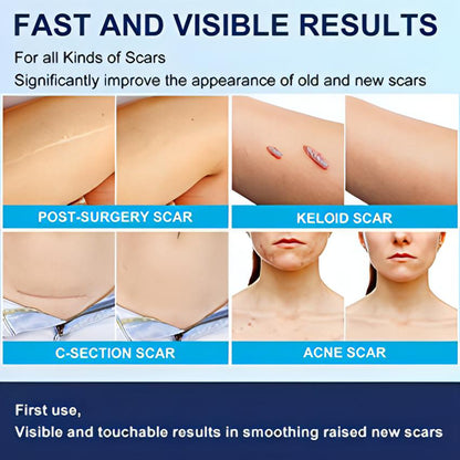 Scar Removal Silicone Gel Sheet | Fades C-Section Scars, Acne Scars, Wound &amp; Operation Scars - NextMamas